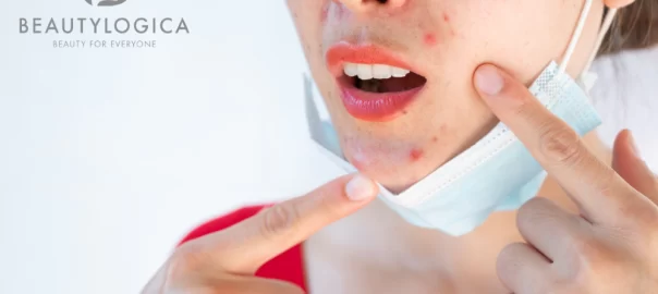cara menghilangkan jerawat meradang dan bekasnya