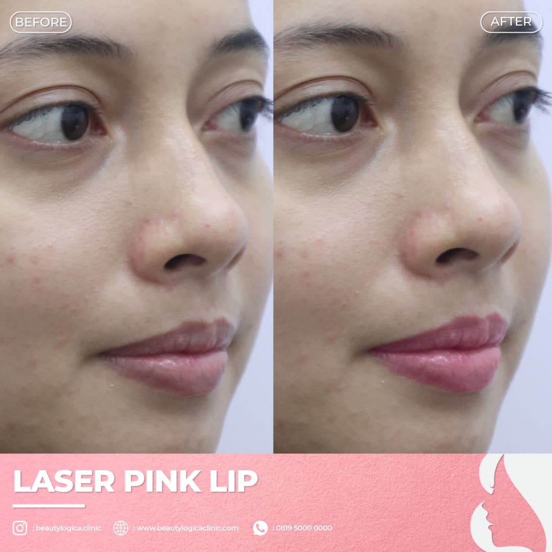 Before After Laser Pink Lip - Laser Bibir