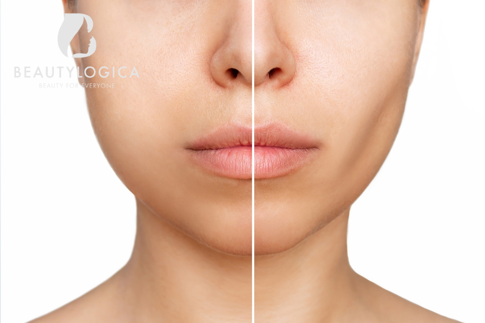 Operasi Buccal Fat Removal