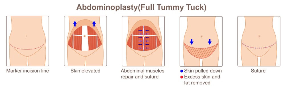 Tummy Tuck - Cara Mengencangkan Perut yang Kendur dan Bergelambir
