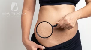 Ragam Cara Menghilangkan Stretch Mark Paling Ampuh