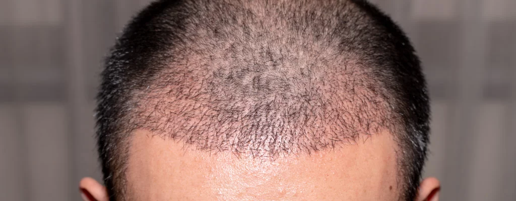 Hair Transplant atau Transplantasi Rambut Hair Transplant atau Transplantasi Rambut